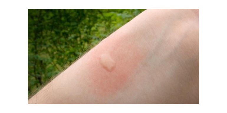 Alergia a Picaduras de Mosquitos